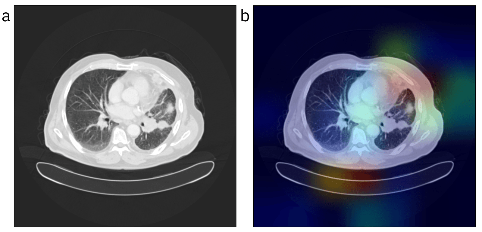 Lung CT scan beside its HiRes-CAM class activation map highlighting the regions FVCM-Net used for a malignant prediction